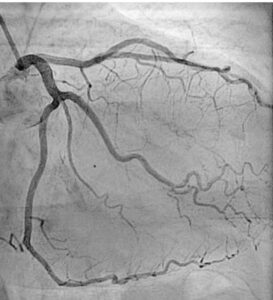 coronary angiography test