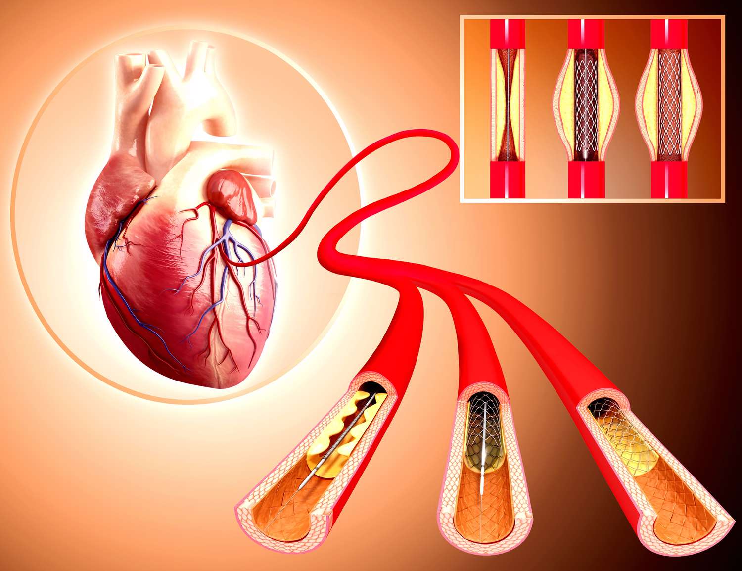 coronary angiography test