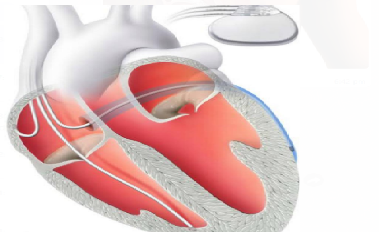 coronary angiography test