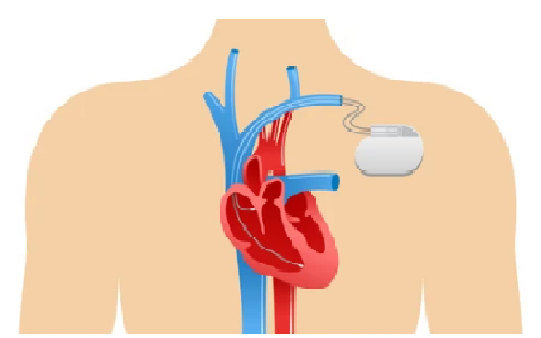 Pacemaker in PCMC Pune