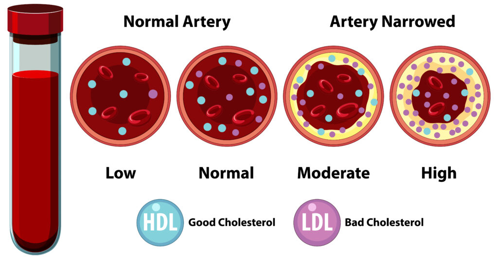 Cholesterol Levels Explained What Your Numbers Really Mean Dr. Dhananjay Zutshi