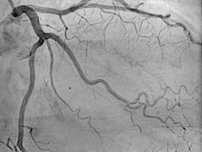 Angioplasry coronary angiography test