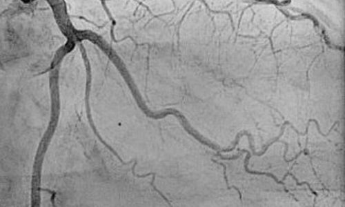 coronary angiography test